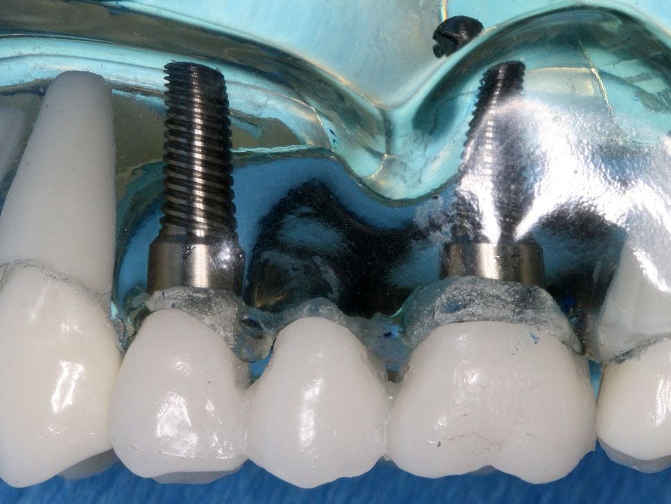 dental implants are more like the teeth